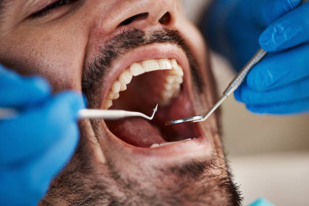 Best Urgent Care for Lost Fillings or Crowns in Spotswood, NJ