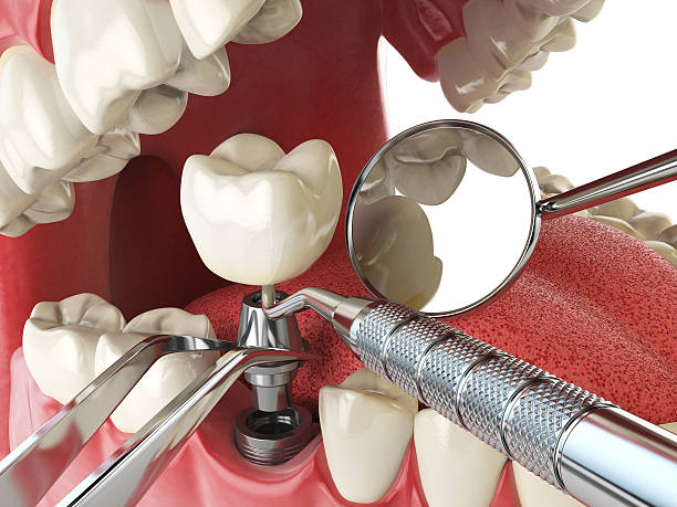 Best Urgent Care for Lost Fillings or Crowns in Spotswood, NJ